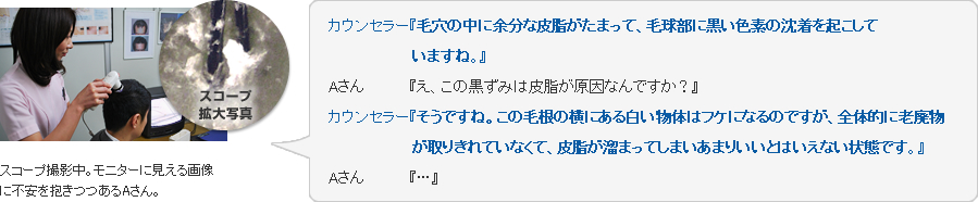 スコープ撮影中。モニターに見える画像に不安を抱きつつあるAさん。カウンセラー『毛穴の中に余分な皮脂がたまって、毛球部に黒い色素の沈着を起こしていますね。』Aさん『え、この黒ずみは皮脂が原因なんですか?』カウンセラー『そうですね。この毛根の横にある白い物体はフケになるのですが、全体的に老廃物が取りきれていなくて、皮脂が溜まってしまいあまりいいとはいえない状態です。』Aさん『…』