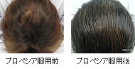 プロペシア服用前・服用後