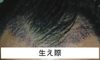 生え際