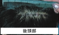 後頭部
