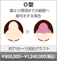 O型 左右のそりこみ部分（M字）へ移植をする場合 約715～1000グラフト \950,000～\1,240,000