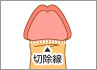 短小（短小包茎）改善法