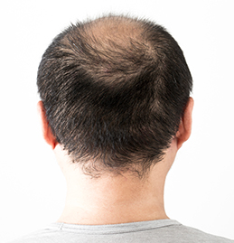 薄毛男性の頭髪の画像