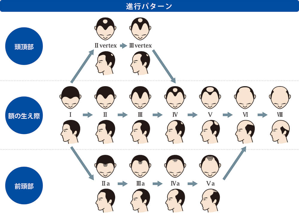 AGAの進行パターン図