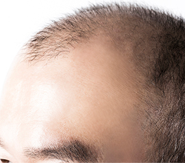 薄毛男性の頭髪の画像
