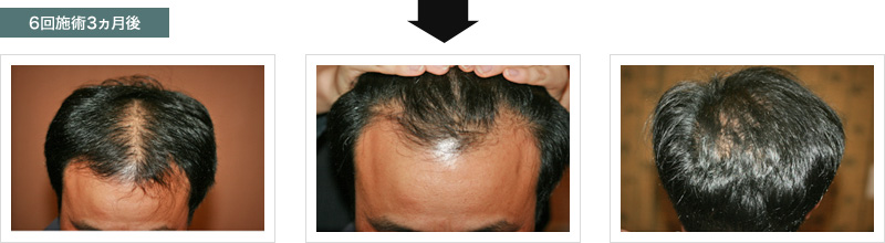 6回施術3ヶ月後の状態