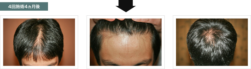 4回施術4ヶ月後の状態