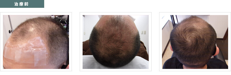薄毛男性の治療前の頭髪
