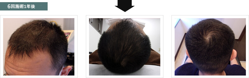 6回施術1年後の状態