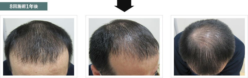 8回施術1年後の状態