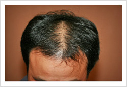 HARG+治療の症例