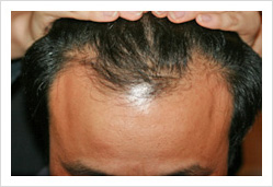 HARG+治療の症例