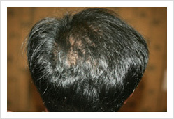 HARG+治療の症例