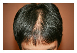 HARG+治療の症例