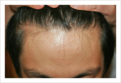 HARG+治療の症例