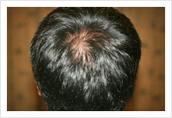 HARG+治療の症例