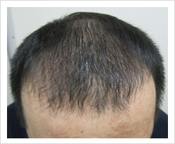 HARG+治療の症例