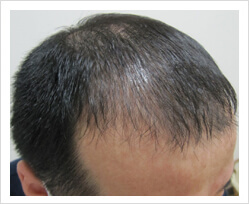 HARG+治療の症例