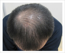 HARG+治療の症例