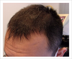 HARG+治療の症例