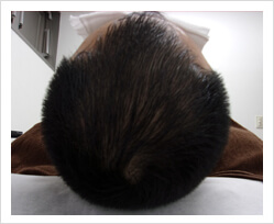 HARG+治療の症例