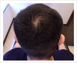 HARG+治療の症例