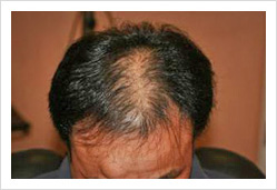 HARG+治療の症例