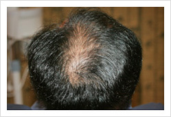 HARG+治療の症例