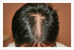 HARG+治療の症例