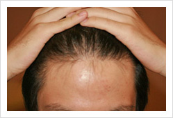 HARG+治療の症例