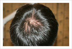 HARG+治療の症例