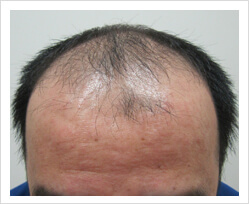 HARG+治療の症例