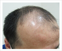 HARG+治療の症例