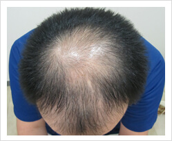 HARG+治療の症例