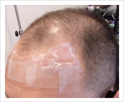 HARG+治療の症例