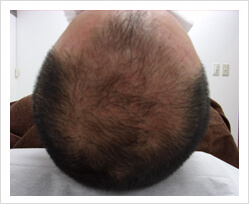 HARG+治療の症例