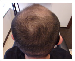 HARG+治療の症例