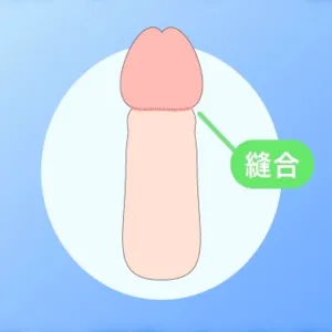 亀頭直下法の仕上がりイメージ。亀頭のすぐ下で縫合する図