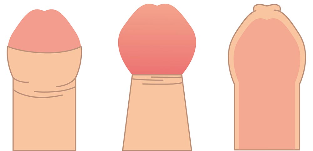 真性包茎は手術が必要?治療するメリットと手術費用の目安