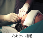 穴あけ、植毛