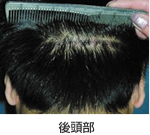 後頭部