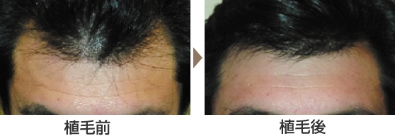 植毛前と植毛後の写真