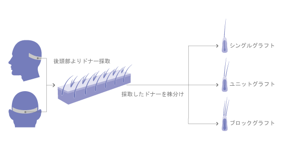 丁寧な手作業によるドナー採取と株分けで、元気な毛根が維持できます