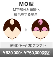 MO型 M字部分と頭部へ移植する場合 約400~500グラフト 630,000~750,000