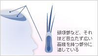 頭頂部など、それほど目立たず広い面積を持つ部分に適している