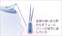 密度の濃い生え際からボリュームゾーンの後方に適している