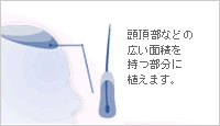 頭頂部など、それほど目立たず広い面積を持つ部分に適している
