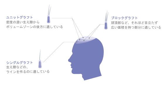 3段階の移植で、自然でムラのない仕上がりを実現！
