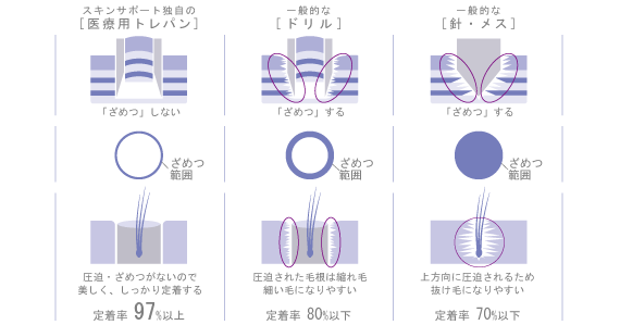 97%の生着率を実現!毛根が定着したら髪が生え続けます!