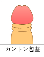カントン包茎